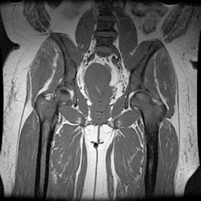 Sickle Cell: femur necrosis and marrow hyperplasia 2: The patient is a black female with sickle cell disease. Note the extensive red marrow reconversion, AVN right hip and both knees and bone infarcts in both femurs.