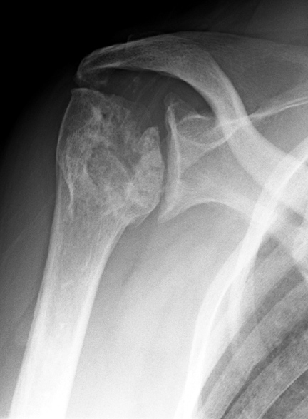 Sickle Cell humeral head necrosis 1: <P>50 year old female with shoulder pain.</P>