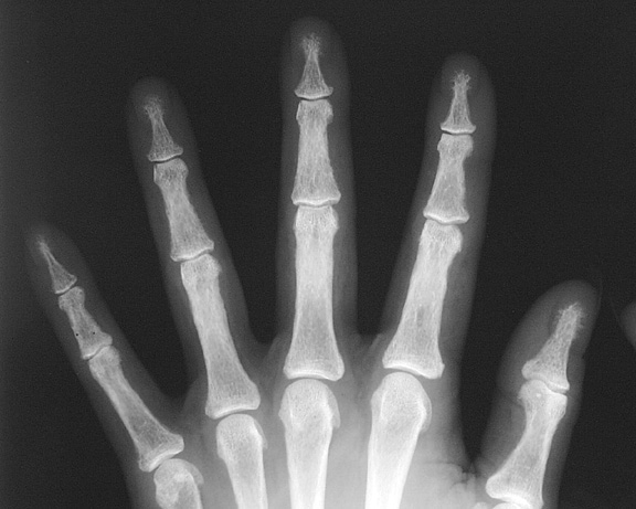 Hyperparathyroidism hand1: 