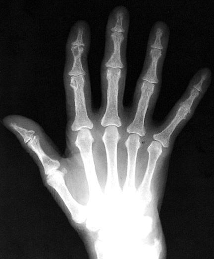 Hyperparathyroidism hand3: 