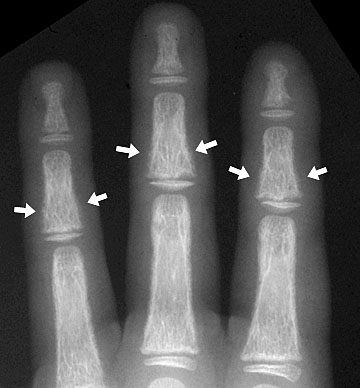 Hyperparathyroidism hand8: 