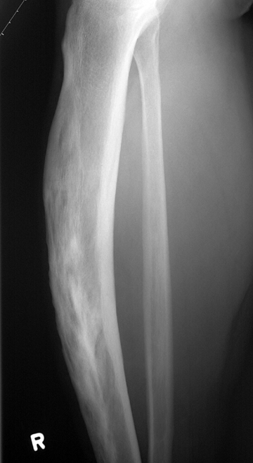 paget bowing: <P>Bowing and cortical thickening of tibia in this patient with Paget's disease.</P>