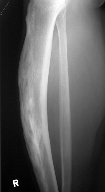 Bowed Tibia