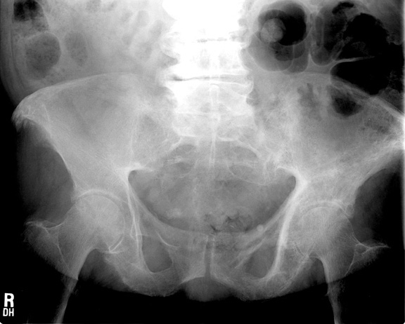 paget pelvis1: <P>Irregular trabecular pattern and density of left ilium and ischium.</P>