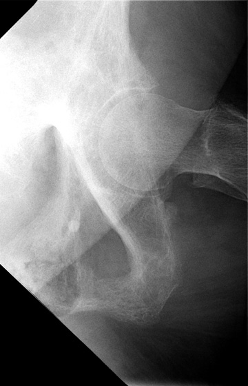 Paget pelvis2: Close up view of hip in same patient, with improved visualization of disorganized trabeculae.