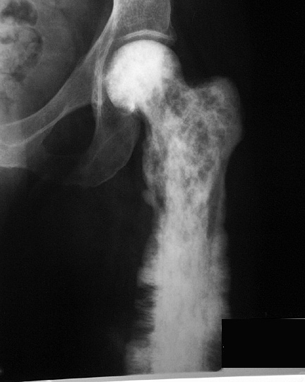 paget's- sarcomatous degeneration: Sarcomatous degeneration of Paget's disease in the proximal femur.