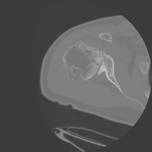 paget ct axial: Axial image of humerus in same patient as above, with typical "swiss cheese" appearance of bone involved by Paget's disease.