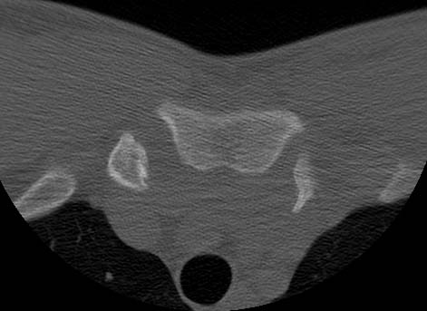 sternoclavicular dislocation axial ct: <P>"axial"</P>