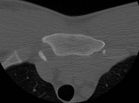 posterior sternoclavicular dislocation avulsion fragment: 