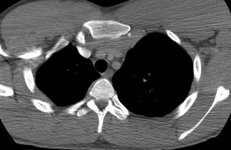 posterior dislocation hematoma: 