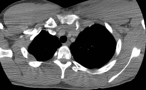 clavicle dislocation post contrast: 