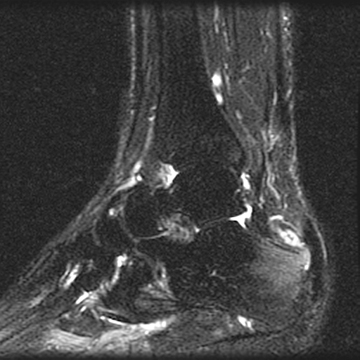 'Insertional achilles