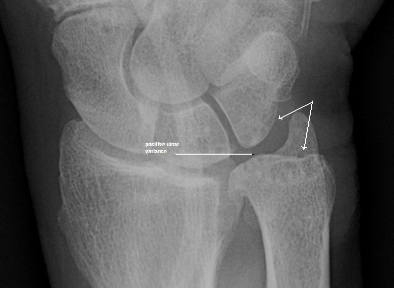 subchondral sclerosis