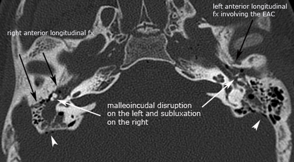 inner ear bone broken