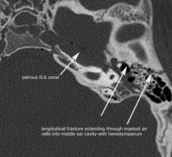 inner ear bone broken