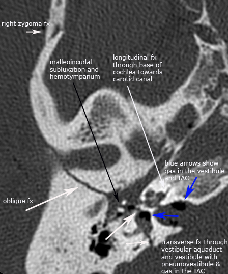 label.axial.complex_fx1.jpg