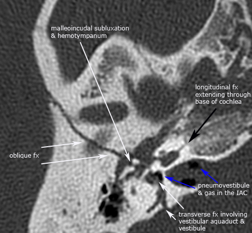 label.axial.complex_fx2.jpg