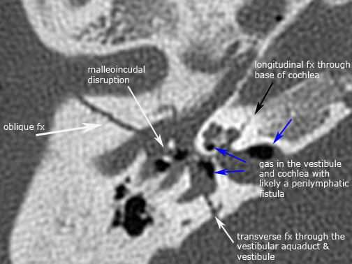 label.axial.complex_fx3.jpg