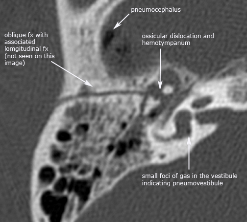 inner ear bone broken