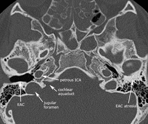 Congenital ear malformations