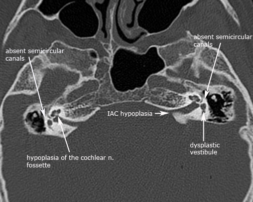 Congenital ear malformations