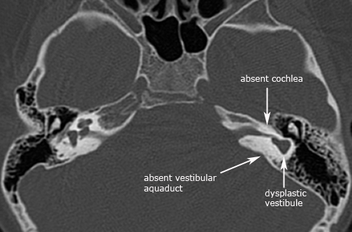 label.cochlear_aplasia_%202.jpg