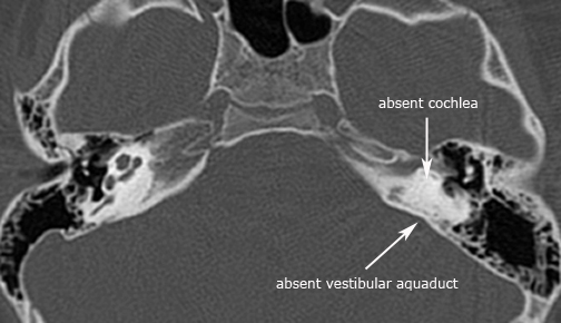 label.cochlear_aplasia_1.jpg