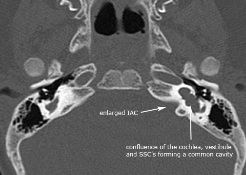 label.axial.common_cavity.jpg