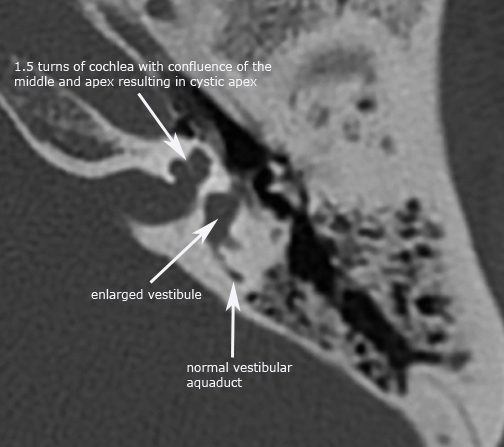 Congenital ear malformations