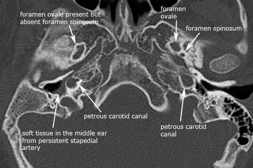 Congenital ear malformations