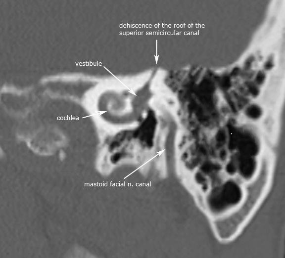 Congenital ear malformations