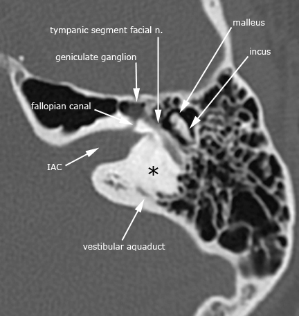 Inflammatory Ear Conditions