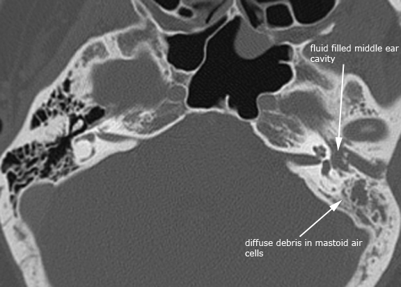 label.Left_OM_axial.jpg