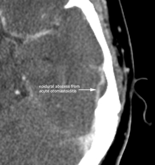 Left_OM_abscess_axial.jpg