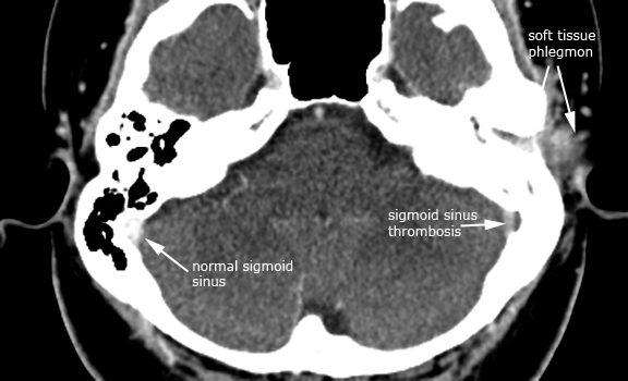 Left_OM_thrombosis_axial.jpg