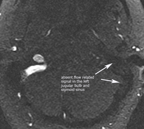 Left_OM_sinusthrombosis_MRV.jpg