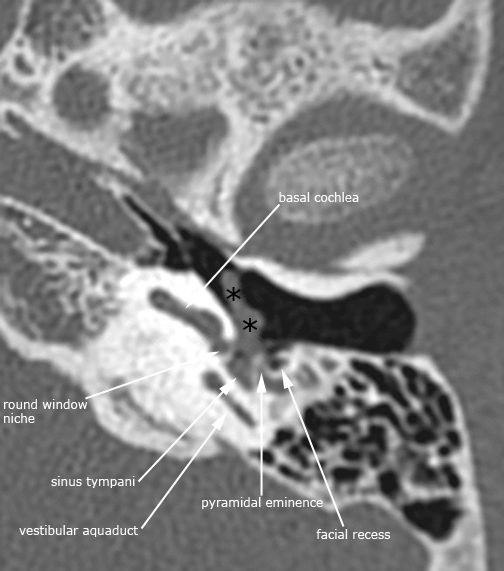 label.Left_PTC_axial.jpg