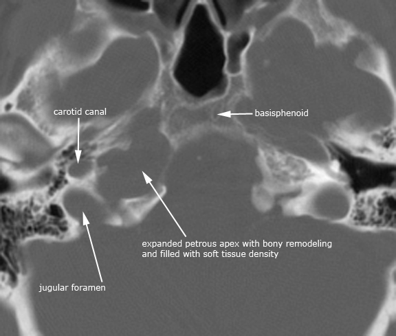 PA_chol_gran_axial1.jpg