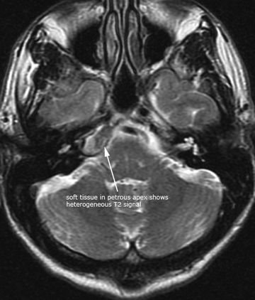 Inflammatory Ear Conditions