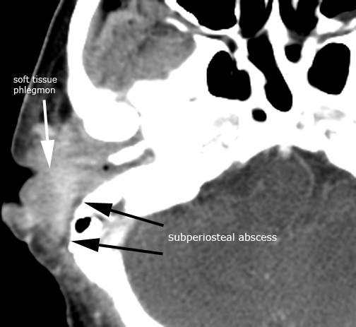 Right_OM_axial1.jpg